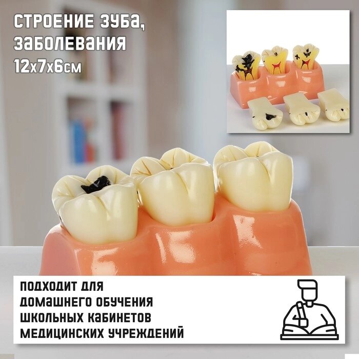 Макет 'Строение зуба, заболевания', 12*7*6см от компании Интернет-магазин "Flap" - фото 1